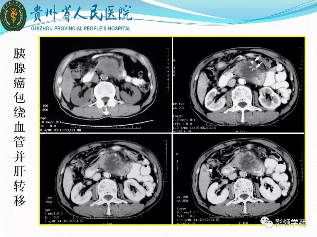 胰腺常见原发肿瘤的ct表现