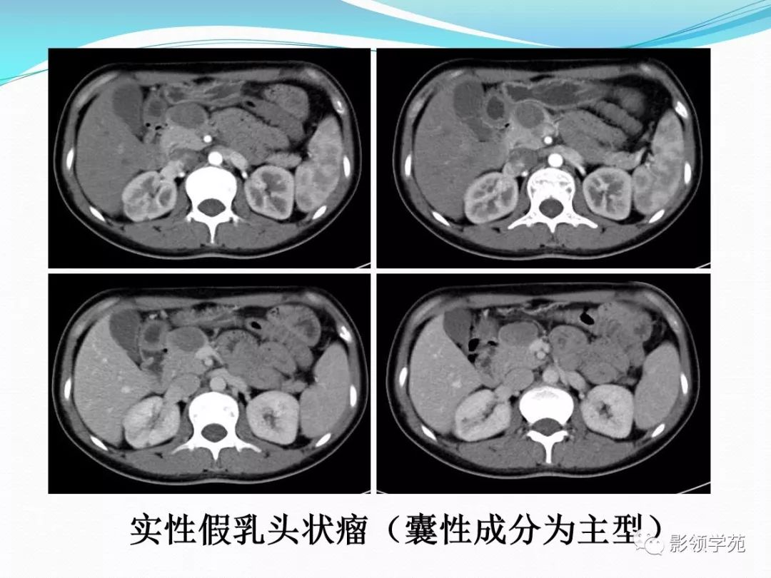 女,16岁,术后病理证实:实性假乳头状瘤胰尾部粘液性囊性癌胰腺粘液性