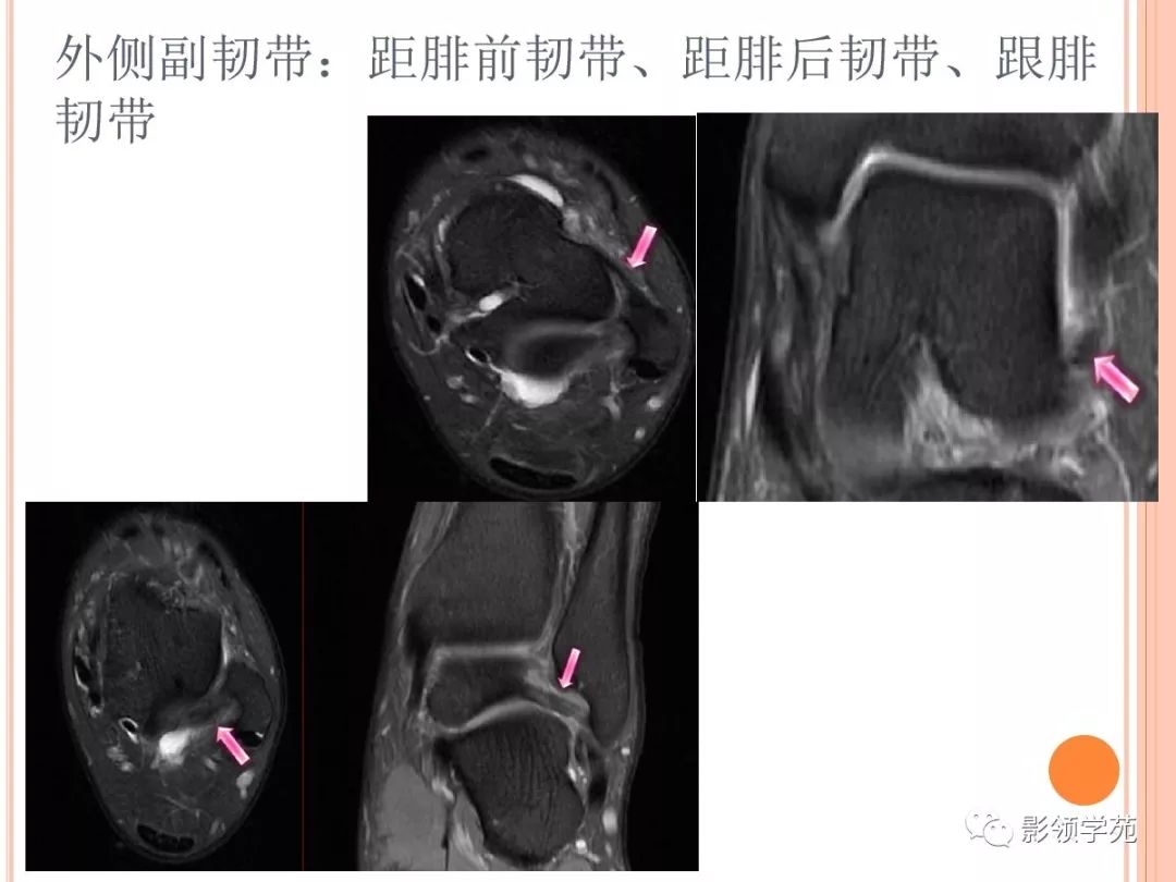 踝关节mri解剖和常见损伤类型