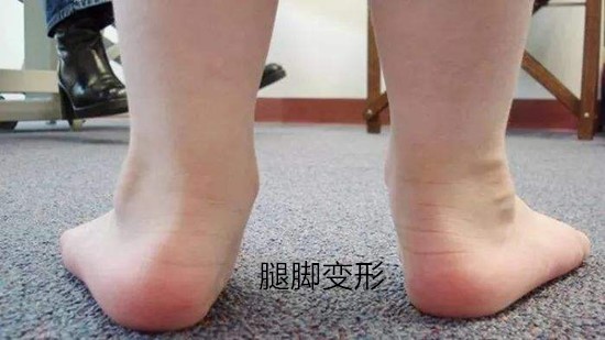 原创5岁宝宝脚趾变形只因家长总是给他穿这种鞋子别舍不得花钱