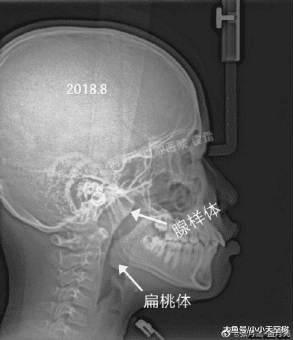 #成长樹#原创当心这个坏习惯，让孩子越长越丑