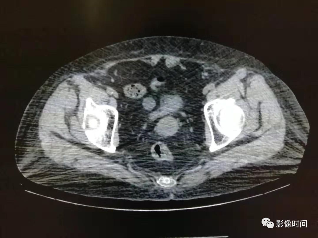 此类伪影的特点是沿着高密度物体周围呈放射状排列,有时 ct 图像上不