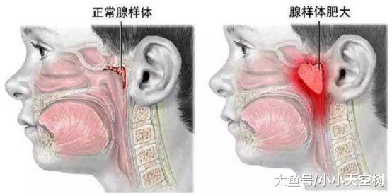 #成长樹#原创当心这个坏习惯，让孩子越长越丑