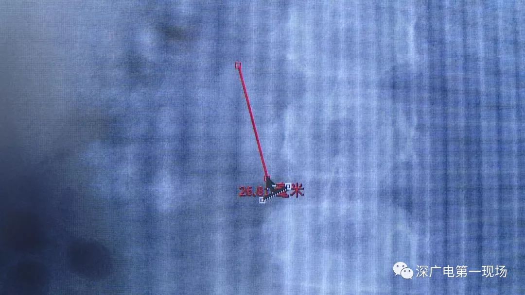 [小学二年级语文]9岁男孩肾里塞了56颗结石！都是家长这个习惯害了他