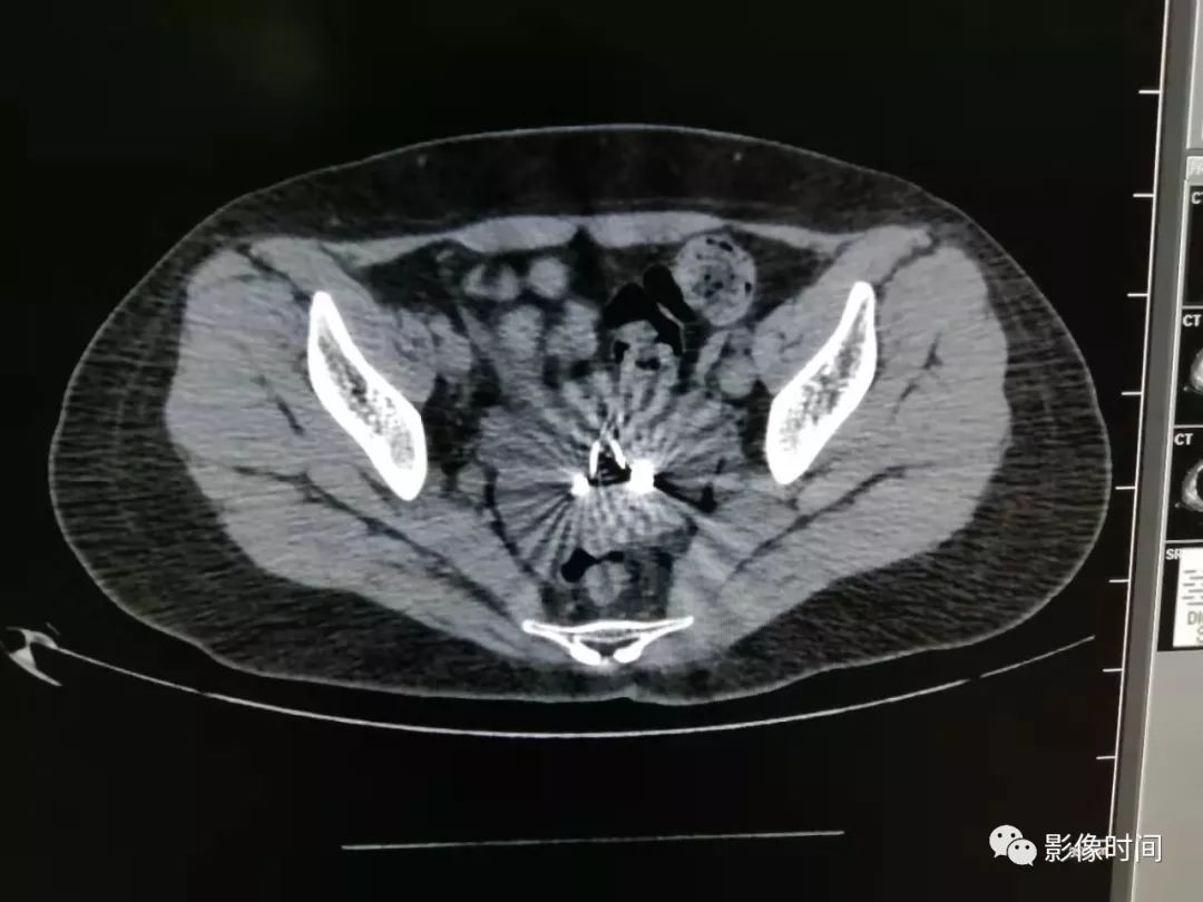 ct检查中那些您可能会忽视的伪影