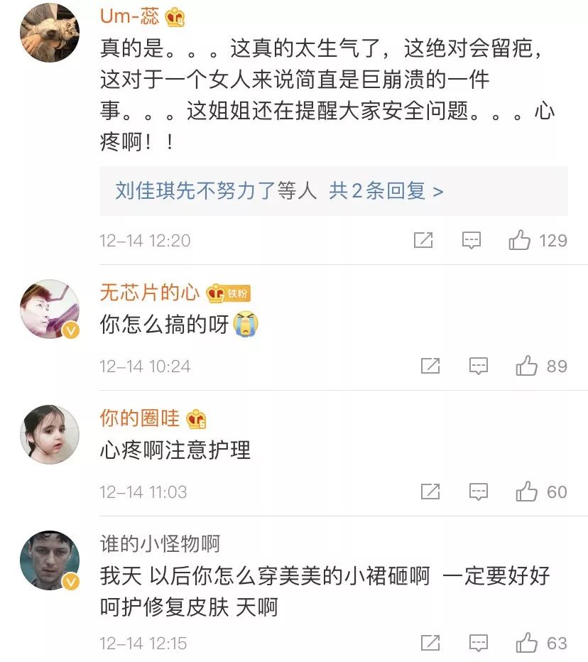 女明星自曝拔火罐被严重烧伤看着好吓人