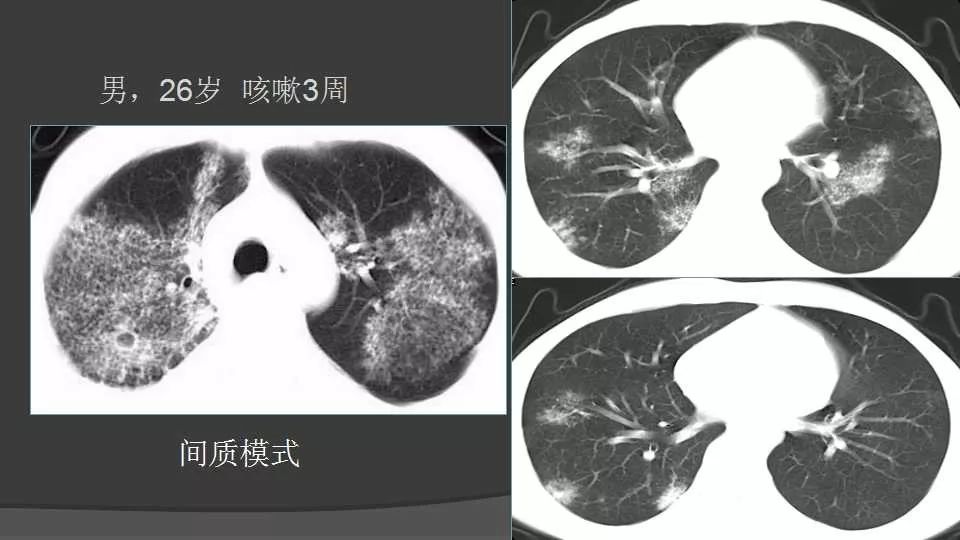 肺结核几种不典型影像模式的思考