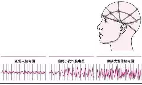 癫痫人口_癫痫发作图片(2)
