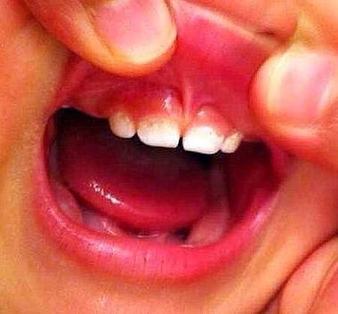 孩子两岁了才长七颗牙齿正常吗？要注意什么？宝妈们需要注意