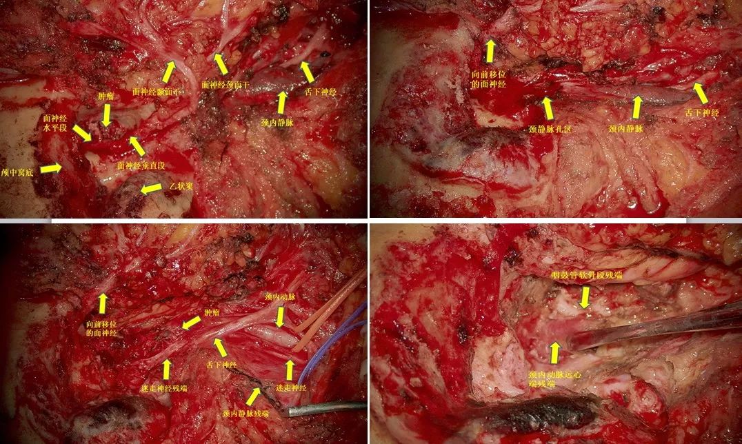 术后mri: 外耳道癌是发生于外耳道上皮系统的恶性肿瘤,主要包括鳞状