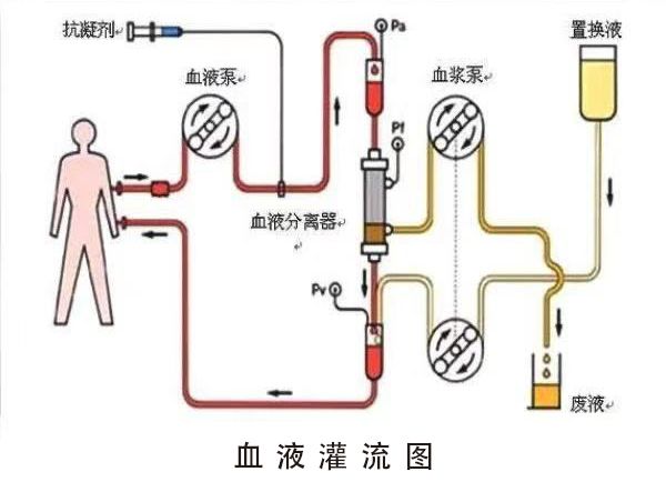 带你了解血液透析和血液灌流