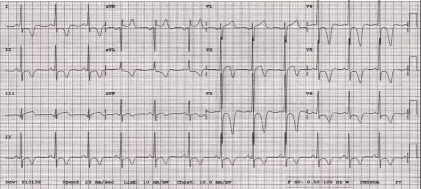 干货丨几种常见心肌病的心电图特征一文掌握