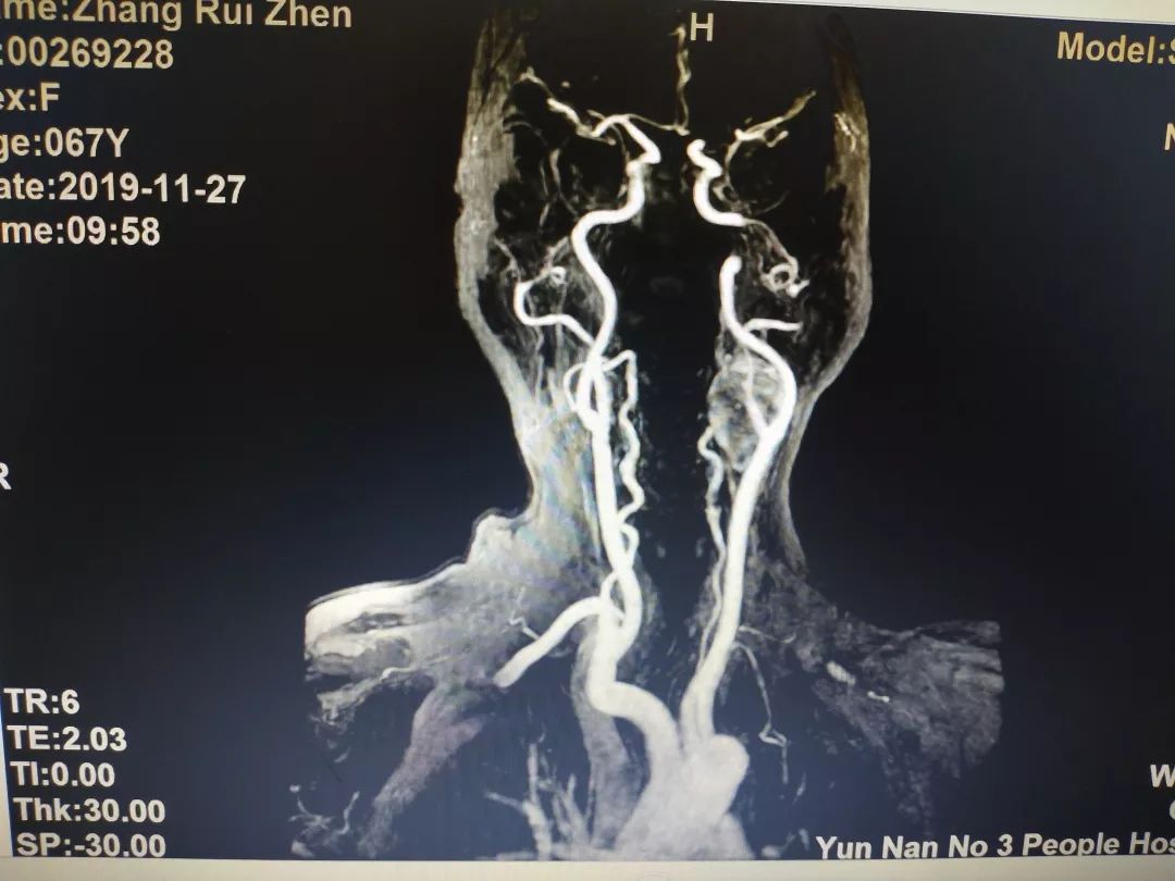 三院医疗现场我院耳鼻咽喉科完成一例巨大颈动脉体瘤切除术