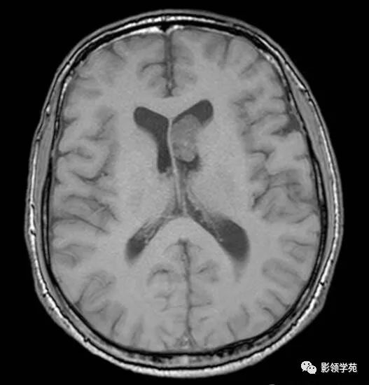 侧脑室内见类圆形稍长t1中等t2信号肿块室管膜下瘤