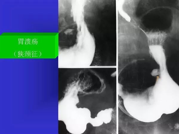 胃十二指肠溃疡与胃癌的影像学表现