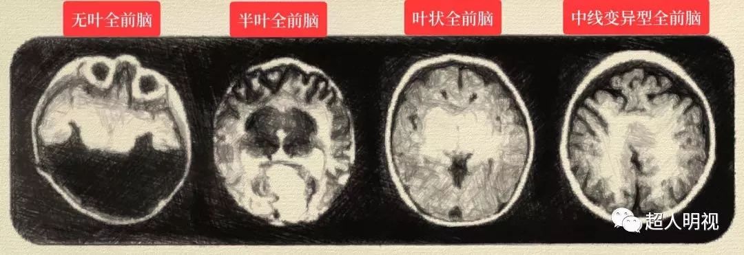 示意图根据前脑不分离的程度,前脑无裂畸形分为四种类型,值得一提的