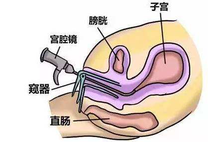 试管刮宫后的注意事项,你值得拥有!_子宫