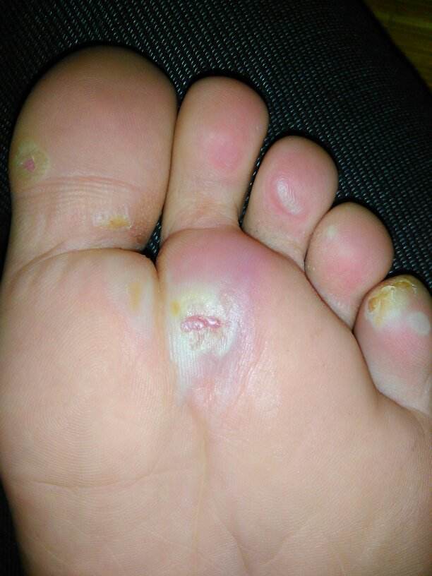 水疱型足癣是脚上起水泡的原因之一,此病多发生在夏季,症状是趾间,足