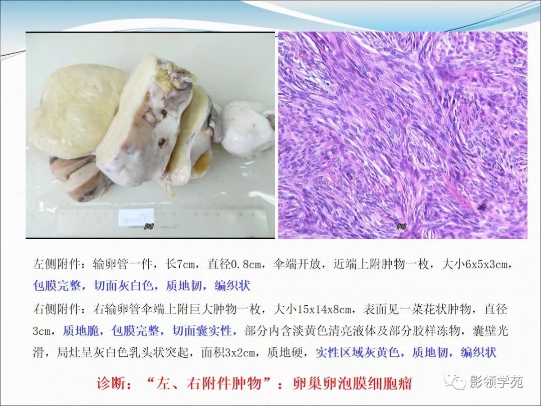 卵巢卵泡膜细胞瘤的影像诊断及病理对照