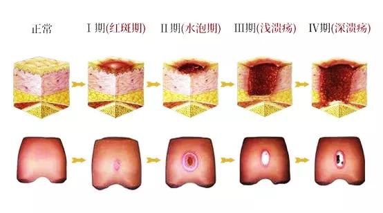 褥疮如何预防*靠*在预防
