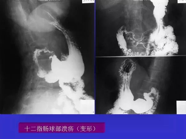 胃十二指肠溃疡与胃癌的影像学表现