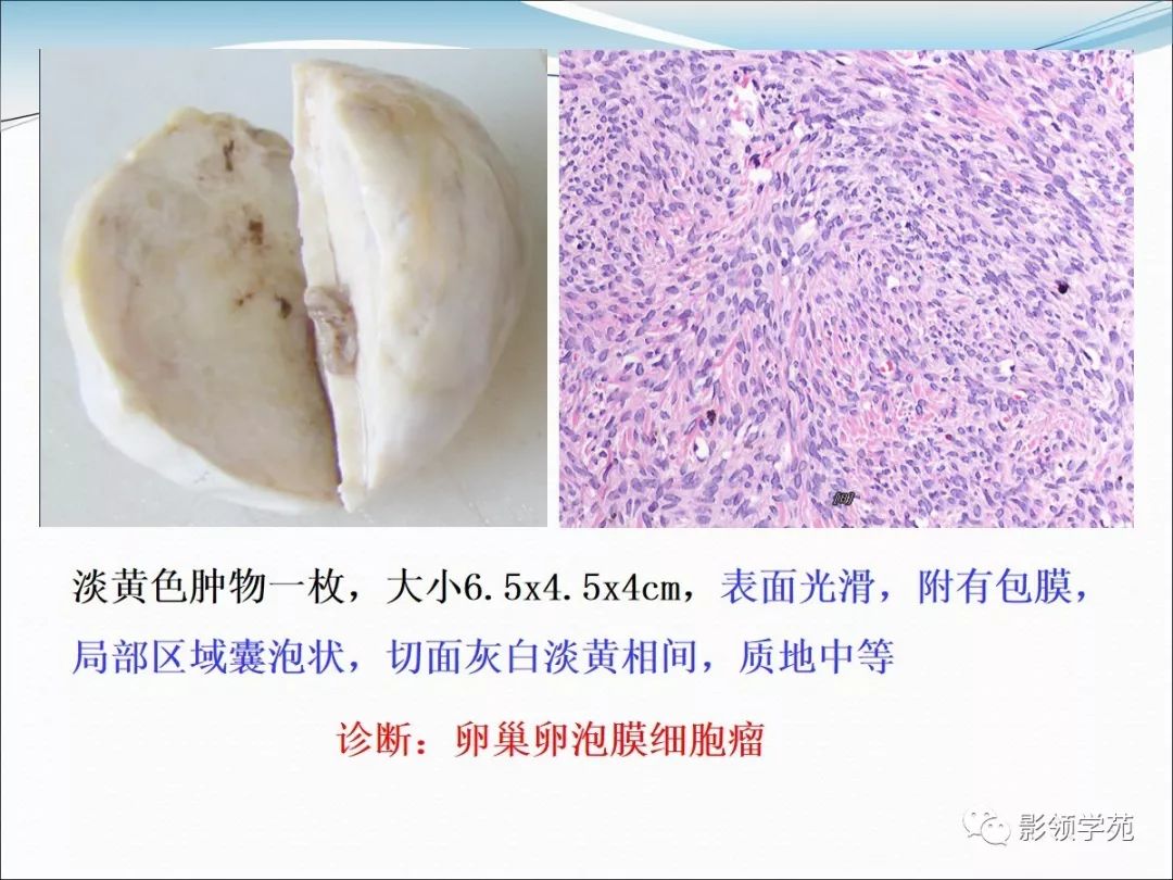 卵巢卵泡膜细胞瘤的影像诊断及病理对照