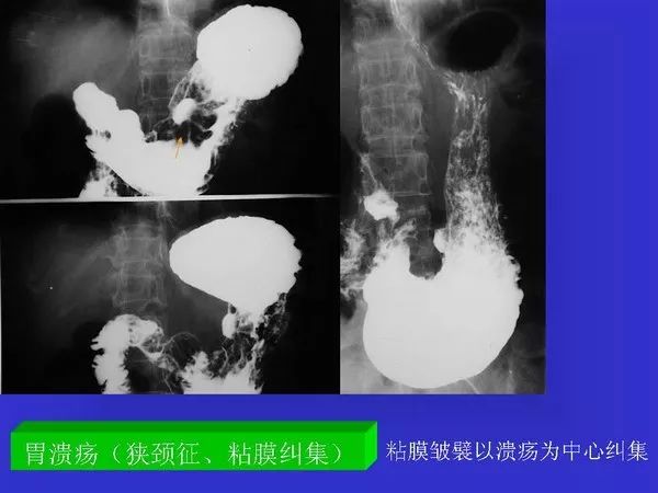 胃十二指肠溃疡与胃癌的影像学表现