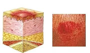 褥疮如何预防?三分靠治疗,七分在预防