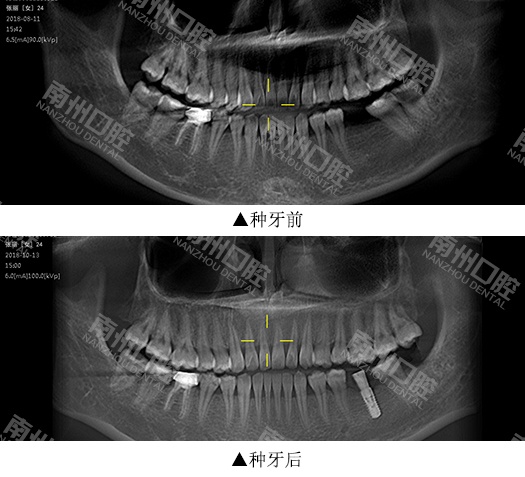 刘医生为其检查设计种植方案,通过评估患者的情况,包括上下颌咬合关系