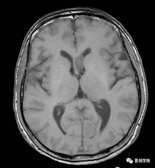 侧脑室内见类圆形稍长t1中等t2信号肿块室管膜下瘤