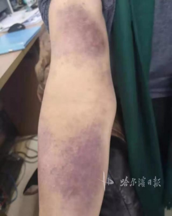 阑尾炎症状吃什么药缓解 d2c20edd33494f5ba2d60a85e9583bcf.jpeg