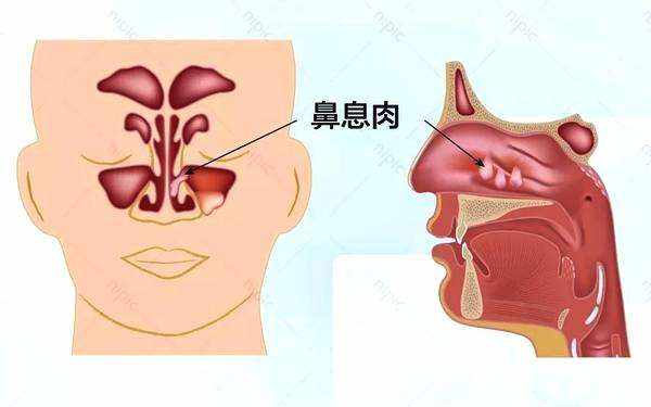 北京首大盛发军为您讲解:鼻息肉是什么?引起鼻息肉的因素有哪些?