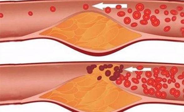 血管堵塞的真凶找到了!医生建议:坚持5点,血管越来越通畅