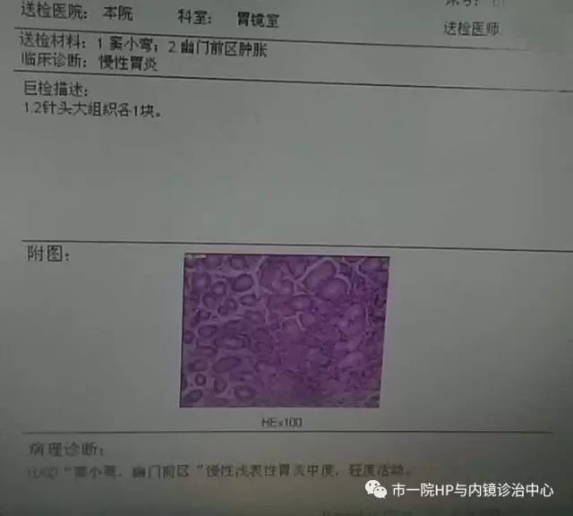 胃癌离我们越来越近这四种人应做胃镜检查专家教你如何看懂胃镜报告