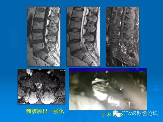 椎间盘退变某些mr征象的再认识