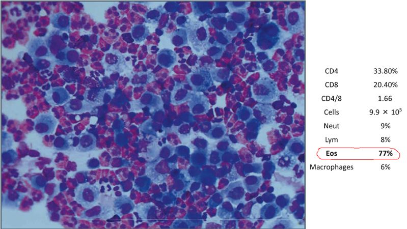 嗜酸粒细胞比例为 77% 及许多巨噬细胞