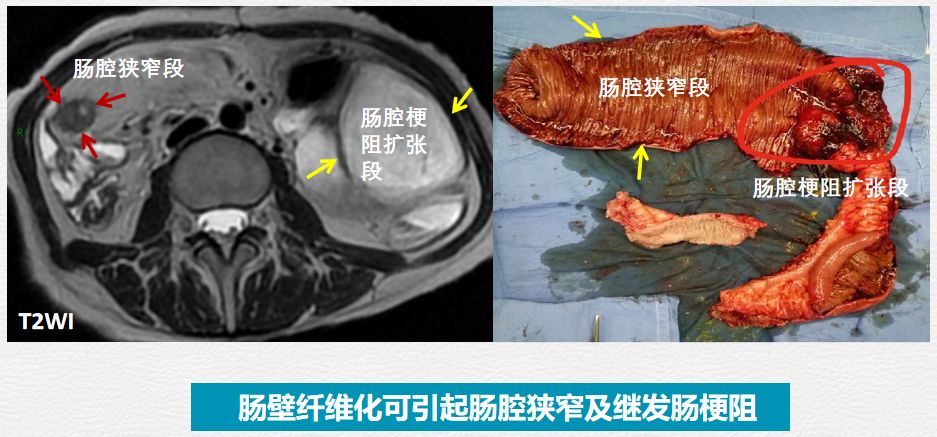 如图所示,左边图片病变肠腔变得非常大,即因为有肠道梗阻,导致肠道