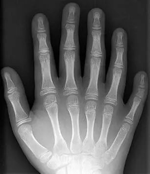 x光下的一只有六个手指的手.