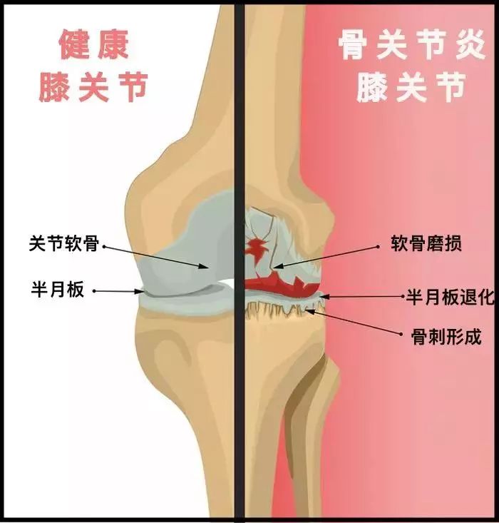 都会使这层关节软骨磨损,退化. 1,减重: 注意