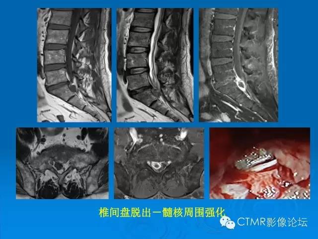 椎间盘退变某些mr征象的再认识