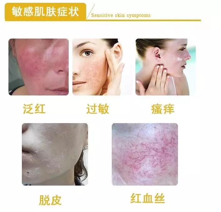 国际上的专家认为敏感性皮肤是一种综合征,意思是各种不适症状(自我