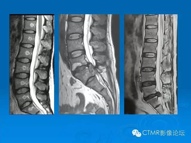 椎间盘退变某些mr征象的再认识