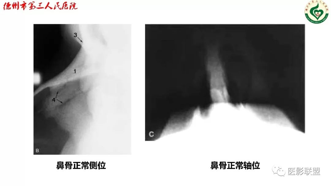 清晰图讲解鼻骨骨折影像学诊断