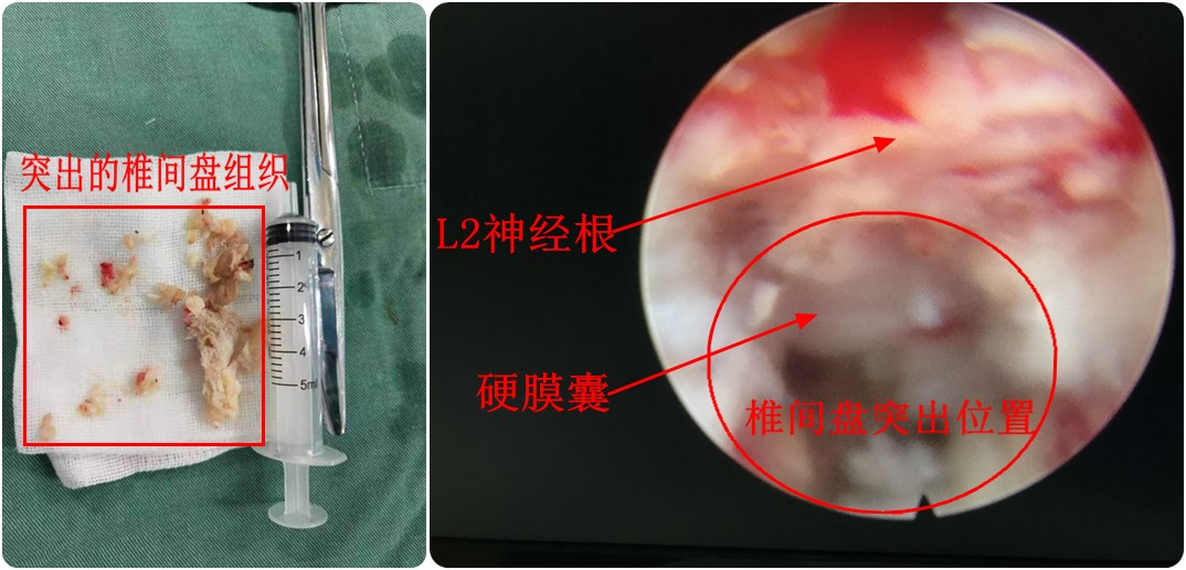 常德市第二人民医院:椎间孔镜手术治愈一例罕见高难度高位椎间盘突出