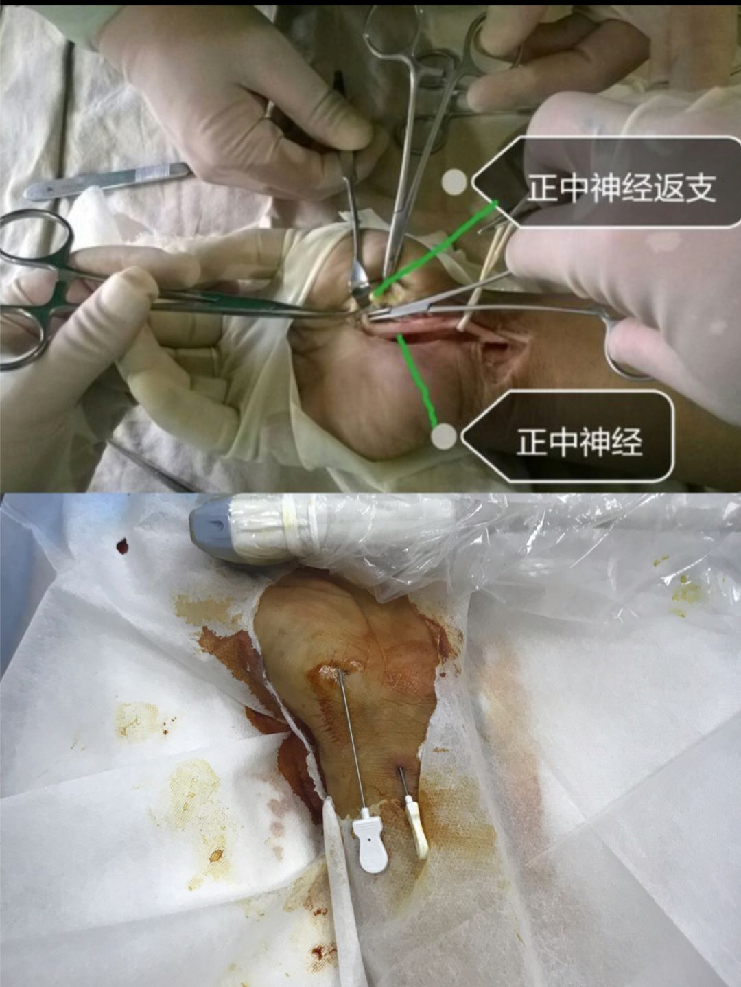腕管综合征常规外科切口与针刀创口比较