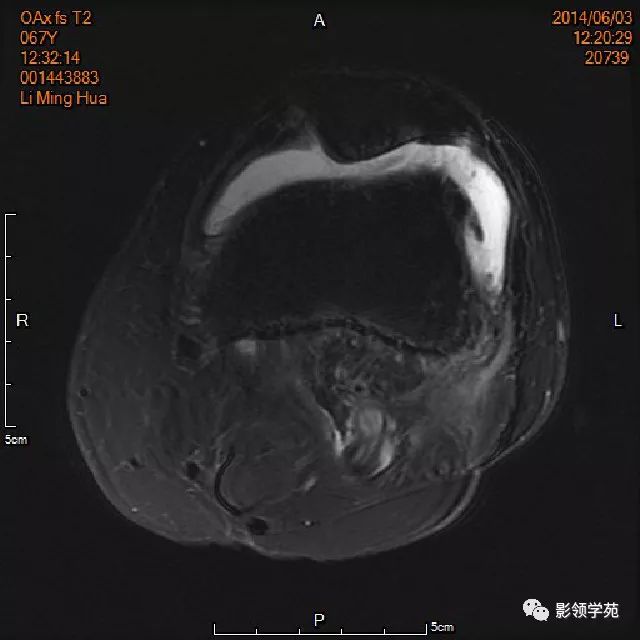 膝关节滑囊的影像解剖