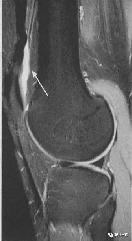 膝关节滑囊的影像解剖