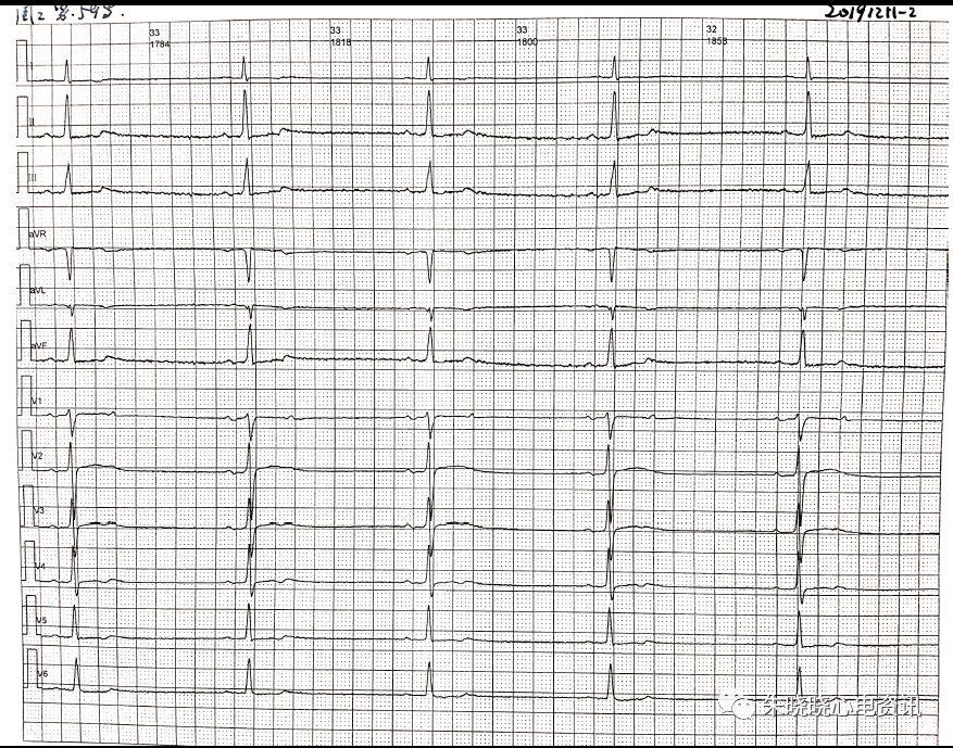 卢老师看心电图 房性早搏二联律伴干扰性p'r间期延长及未下传心室