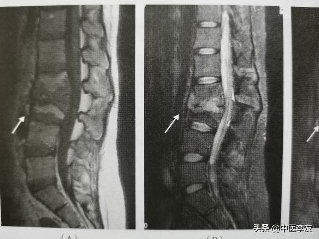 治疗腰背疼痛,要排除脊柱骨关节结核存在的可能性