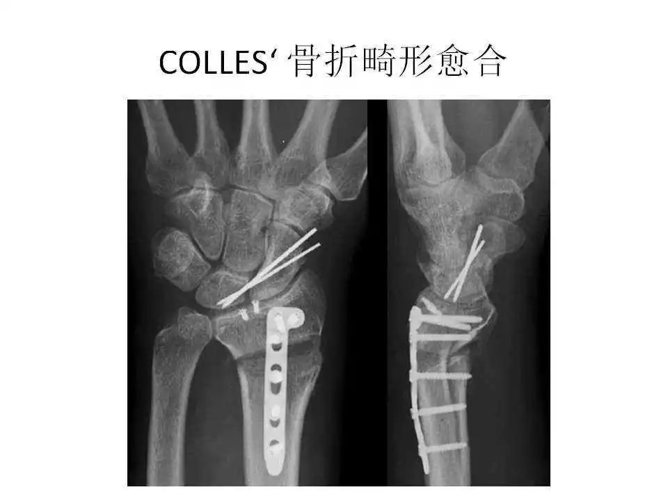 三,畸形愈合引发的纠纷